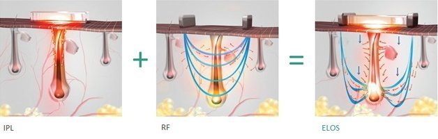 IPL+RF=ELOS