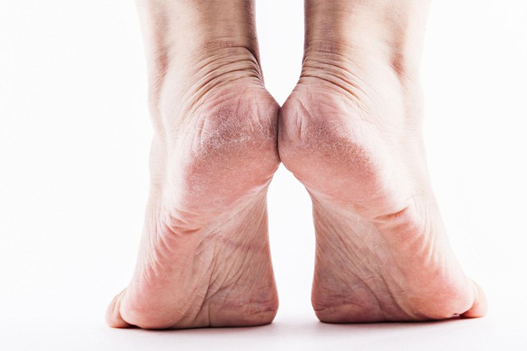 Почему грубеют пятки на ногах причины и лечение thumbnail