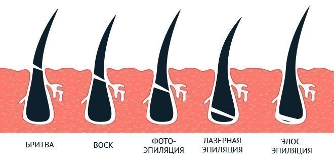 Удаление волос на лице навсегда в домашних условиях и в салоне, способы и средства