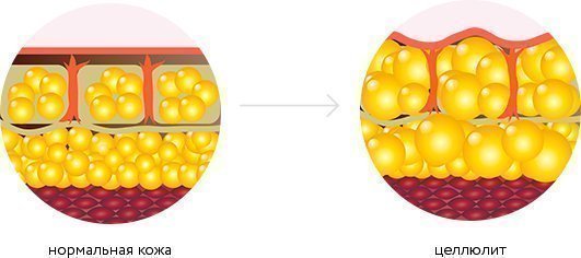 Расщепление целлюлита в домашних условиях
