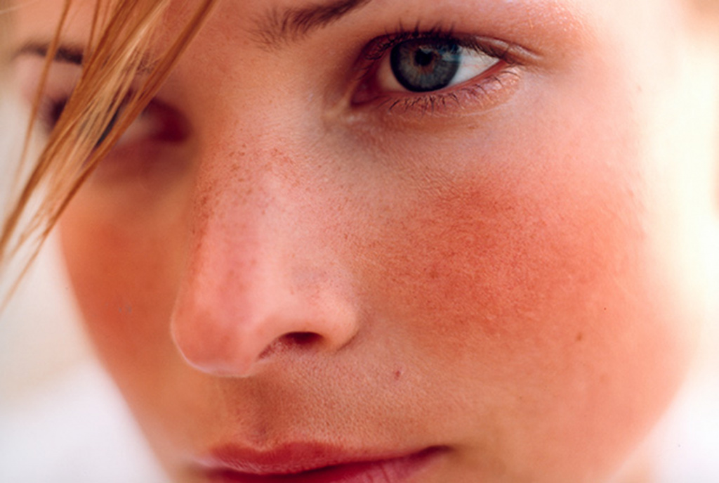 rosacea-5.jpg